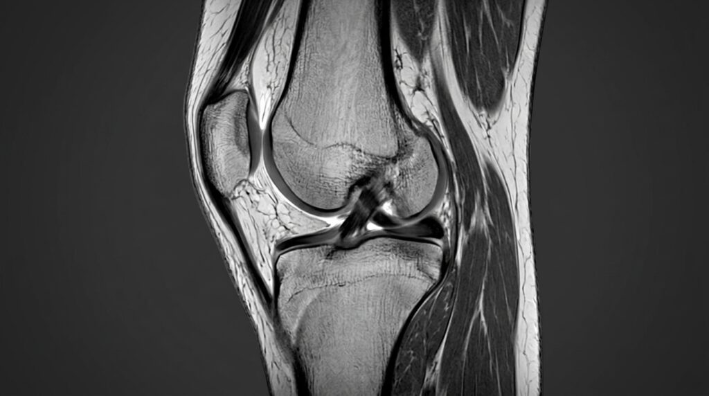 인대, 연골, 반월상 연골판 등 연부 조직이 선명하게 보이는 무릎 MRI 스캔 이미지