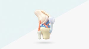 무릎 십자인대 파열, 수술은 필수일까요?